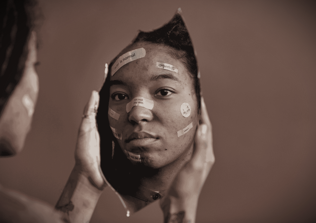 Young woman sitting in front of a mirror, looking at her reflection, with adhesive notes and plasters on her face showing messages like “acne is normal” and “I’m not my skin,” symbolizing body dysmorphia and self-acceptance.