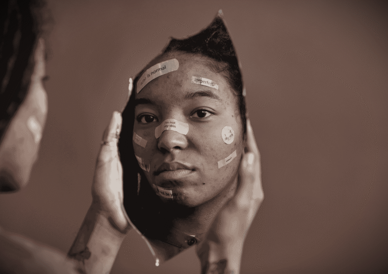 Young woman sitting in front of a mirror, looking at her reflection, with adhesive notes and plasters on her face showing messages like “acne is normal” and “I’m not my skin,” symbolizing body dysmorphia and self-acceptance.